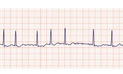 Eskişehir'de uzmanı uyardı: İnme riskini 5 kat artırıyor