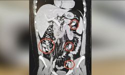 Eskişehir'i zehirleyecekti, midesinden kapsül kapsül çıktı!