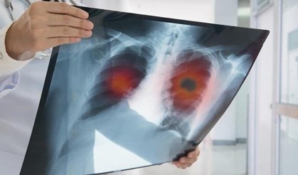 Uzmanlardan kritik uyarı: Hastalığın en büyük risk faktörü sigara!