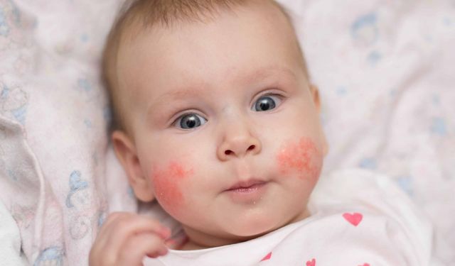 Egzama nedir, egzamaya ne iyi gelir, egzamaya iyi gelen doğal yöntemler nelerdir?