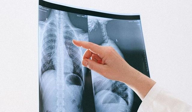 Akciğer kanseri her yıl milyonlarca can alıyor: En büyük sebebi!