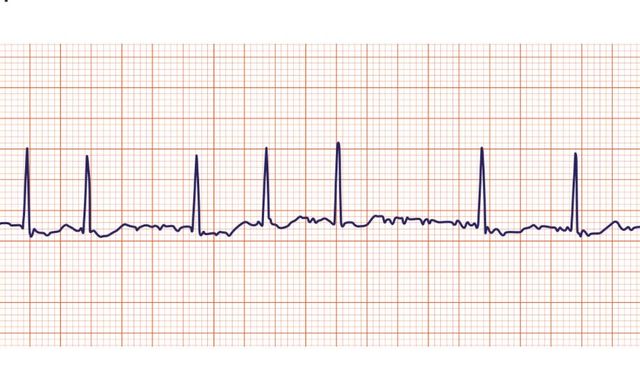 Eskişehir'de uzmanı uyardı: İnme riskini 5 kat artırıyor