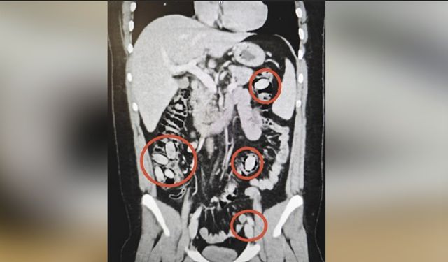 Eskişehir'i zehirleyecekti, midesinden kapsül kapsül çıktı!